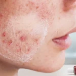 Hipokort Krem Cilt Lekelerine İyi Gelir mi? Nasıl Kullanılır?